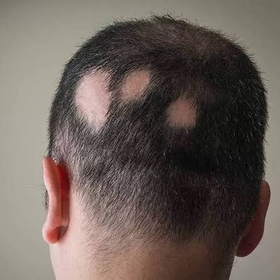 Causes and Treatments of Alopecia Areata (Patchy Hair Loss)