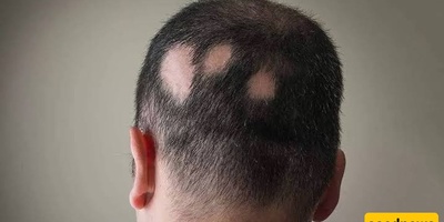 Causes and Treatments of Alopecia Areata (Patchy Hair Loss)