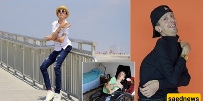 The Man Dubbed “Stone Man” Due to a Rare Disease