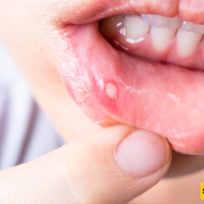 Treat Mouth Sores at Home; Several Simple and Effective Remedies