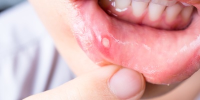 Treat Mouth Sores at Home; Several Simple and Effective Remedies