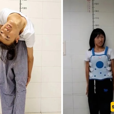 The Bizarre Case of a Woman Whose Spine Bent 180 Degrees Backward, Bringing Her Head to Her Waist [Photo]