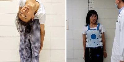 The Bizarre Case of a Woman Whose Spine Bent 180 Degrees Backward, Bringing Her Head to Her Waist [Photo]