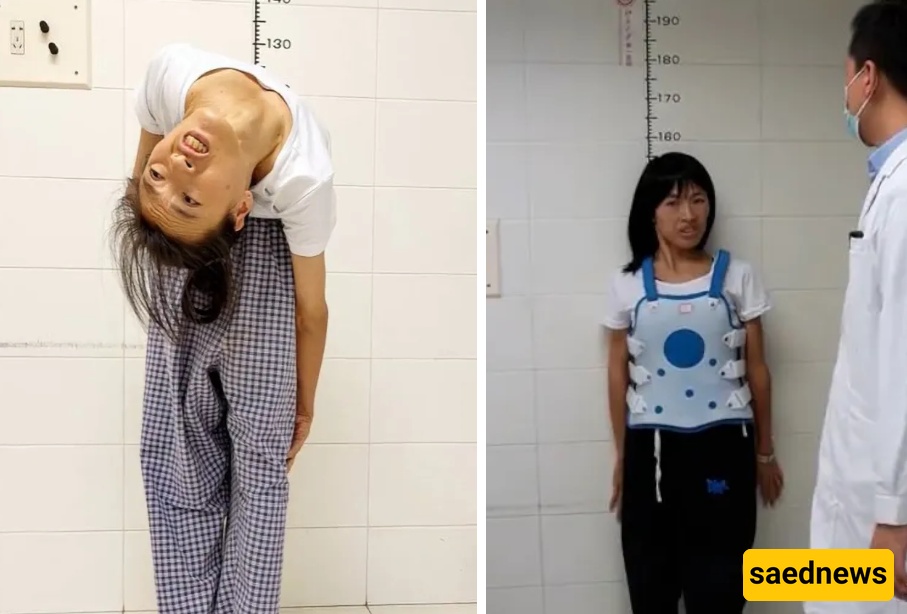 The Bizarre Case of a Woman Whose Spine Bent 180 Degrees Backward, Bringing Her Head to Her Waist [Photo]