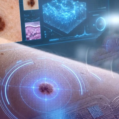 A Smart Tattoo Device Developed to Detect Skin Cancer