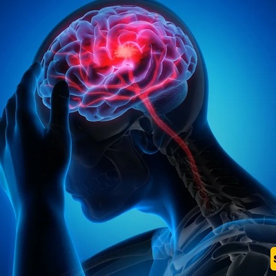 Early Signs of Stroke That Are Often Overlooked