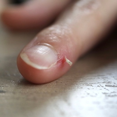 Why Does The Skin Around The Nails Dry Out And Peel So Easily?