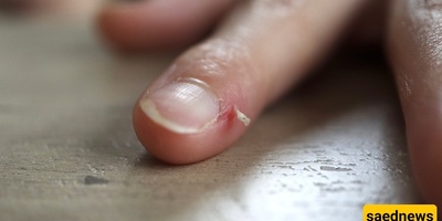 Why Does The Skin Around The Nails Dry Out And Peel So Easily?
