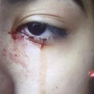 The Girl Who Cries Blood!