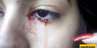 The Girl Who Cries Blood!