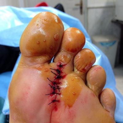 At-Home Treatments for Foot Corns Without Surgery