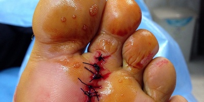 At-Home Treatments for Foot Corns Without Surgery