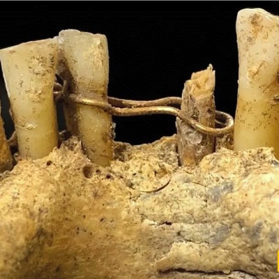 Discovery of “Golden Dental Wiring” in a 500-Year-Old Cemetery