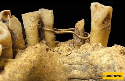 Discovery of “Golden Dental Wiring” in a 500-Year-Old Cemetery