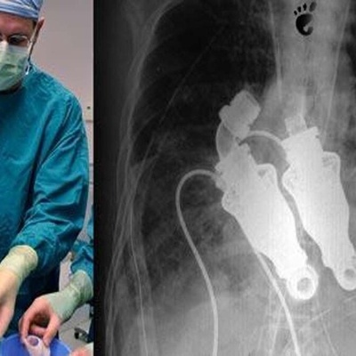 The Only Living Human Without a Heart in the World +Photo