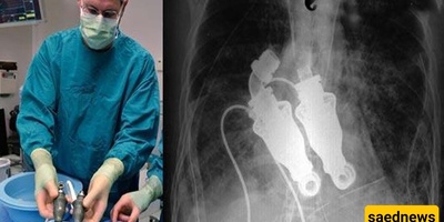 The Only Living Human Without a Heart in the World +Photo