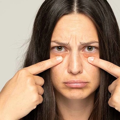 Why Are Your Eyes Puffy After Waking Up?