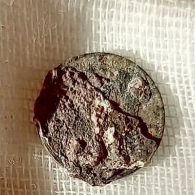 The Man Who Lived Half a Century with a Coin Lodged in His Nose!