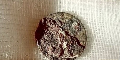 The Man Who Lived Half a Century with a Coin Lodged in His Nose!