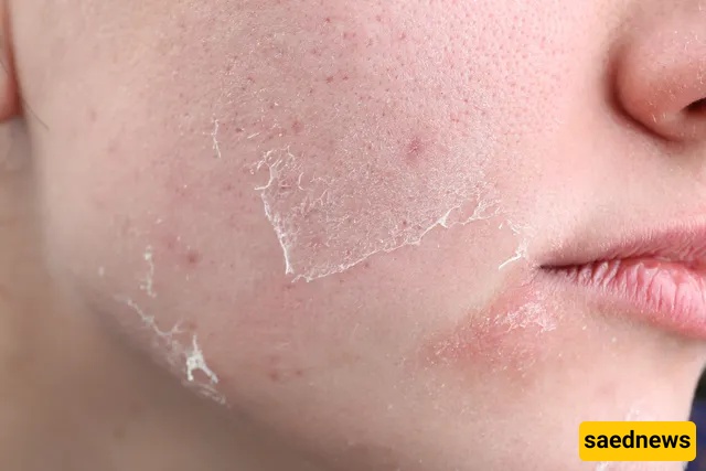 dehydrated skin