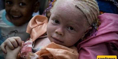 The Inhumane Practice of Albino Killing in Africa!