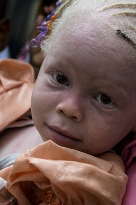 The Inhumane Practice of Albino Killing in Africa!