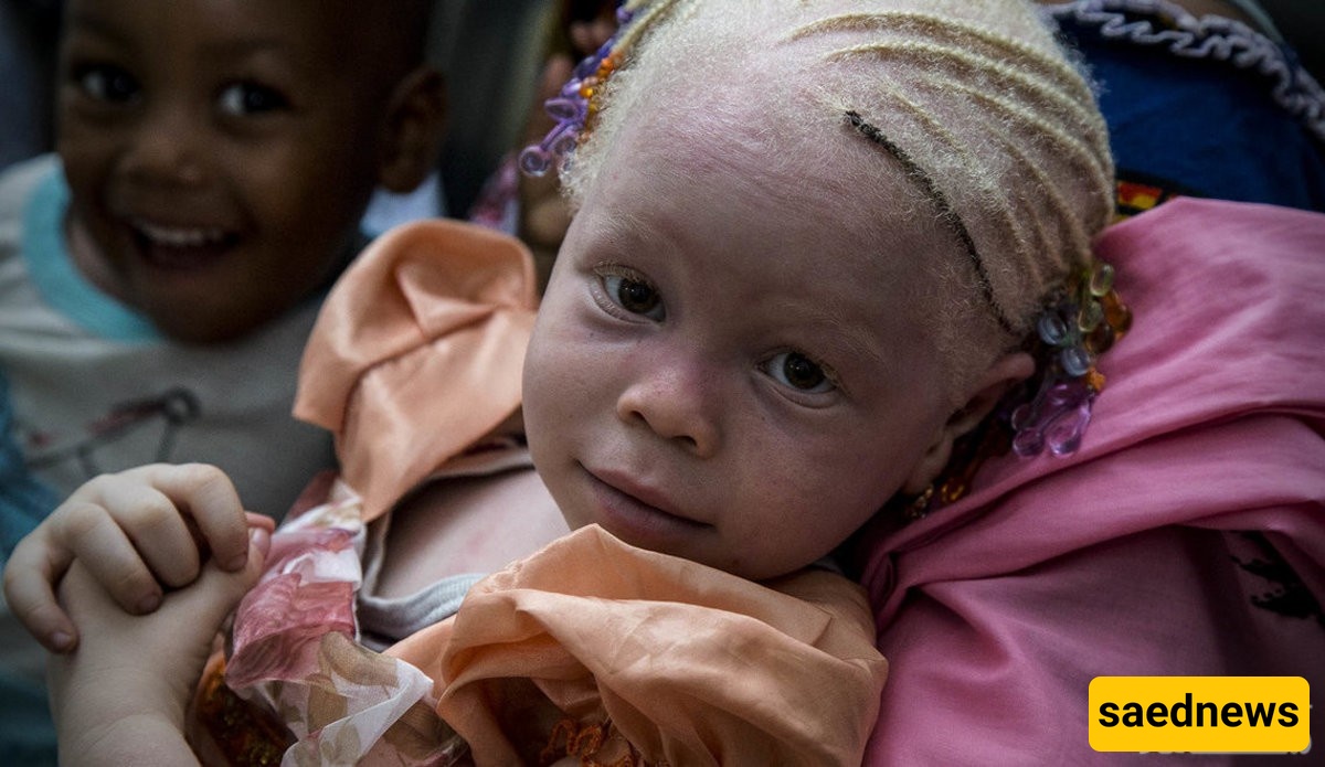 The Inhumane Practice of Albino Killing in Africa!
