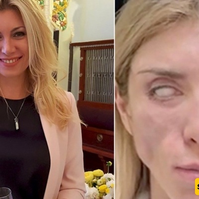 Russian Beauty Queen Suffers Devastating Consequences After Surgery