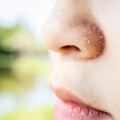 Why Does The Skin Around The Nose Dry Out Faster In Cold Weather?