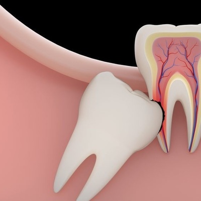 (Video) How Is A Wisdom Tooth Extracted?