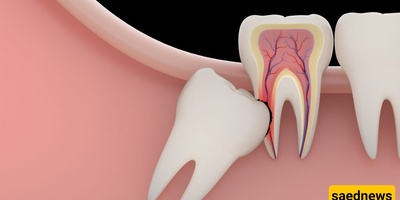 (Video) How Is A Wisdom Tooth Extracted?