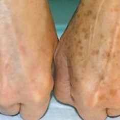 What Causes Brown Spots to Appear on the Skin?