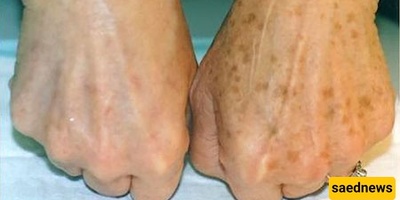 What Causes Brown Spots to Appear on the Skin?