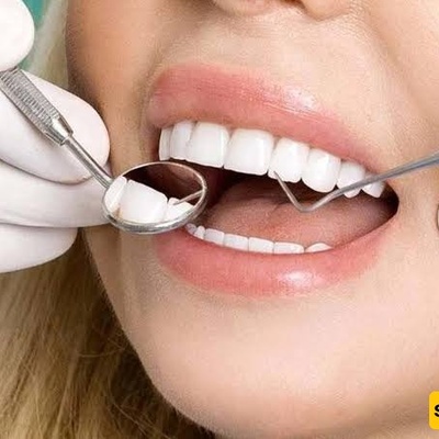Why Does Dental Composite Chip? Causes and Repair Solutions