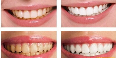 Does Scaling Harm Tooth Enamel? / Benefits of Regular Dental Scaling