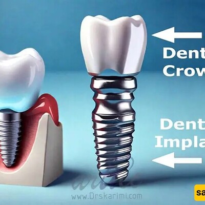 Everything You Need to Know About Implant Crown Dislodgement!