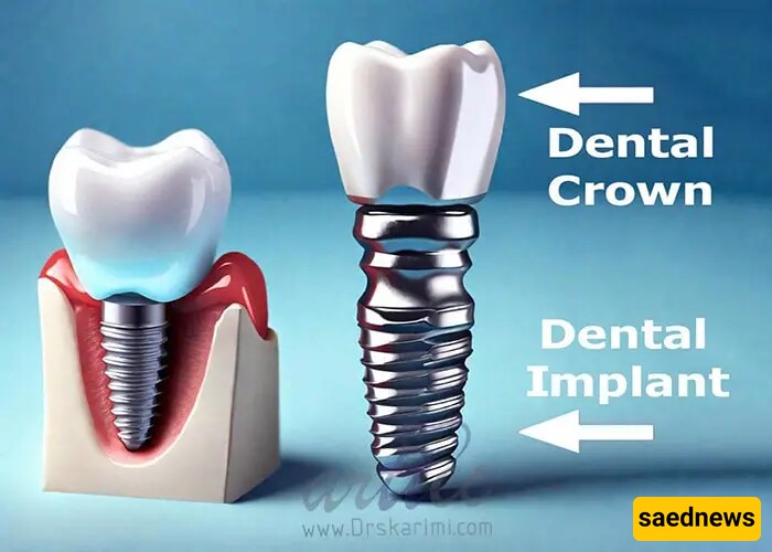 Everything You Need to Know About Implant Crown Dislodgement!