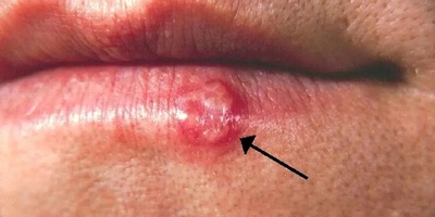 The Link Between Herpes Simplex and a Dangerous Disease in Old Age