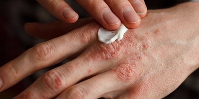 What Causes Itchy Palms?