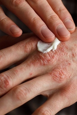 What Causes Itchy Palms?