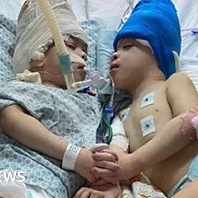 Surgery of Conjoined Twins Using Virtual Reality Technology!