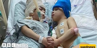 Surgery of Conjoined Twins Using Virtual Reality Technology!