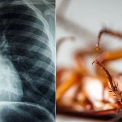 Removing a 4-Centimeter Live Cockroach from the Lung of a 55-Year-Old Man