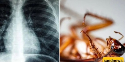 Removing a 4-Centimeter Live Cockroach from the Lung of a 55-Year-Old Man