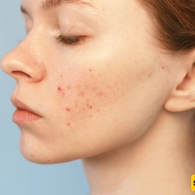 Cholesterol Warning Signs On The Skin; From Yellow Spots To Changes In Foot Color