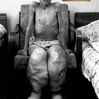 A Child’s Leg Overgrowth Caused by Radioactive Leakage from the Chernobyl Nuclear Power Plant