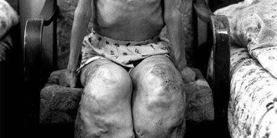 A Child’s Leg Overgrowth Caused by Radioactive Leakage from the Chernobyl Nuclear Power Plant