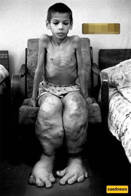 A Child’s Leg Overgrowth Caused by Radioactive Leakage from the Chernobyl Nuclear Power Plant