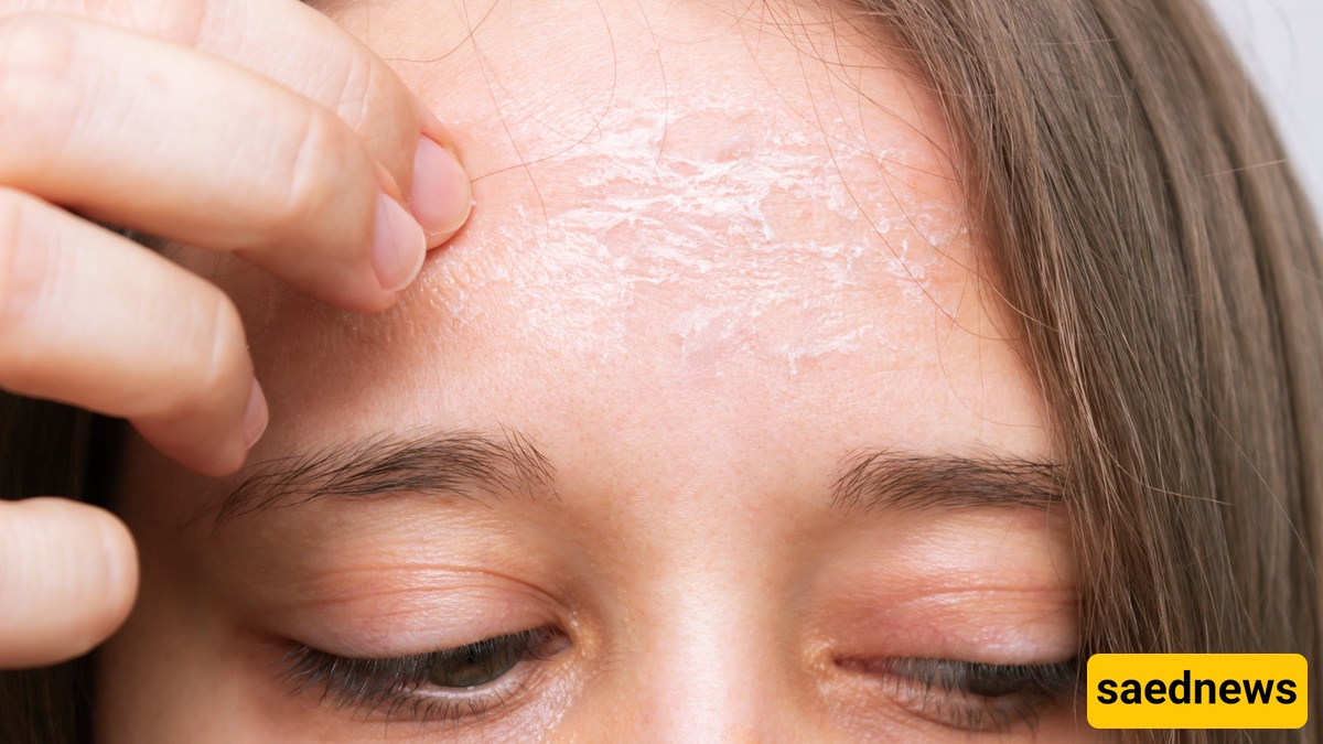 Dry Skin