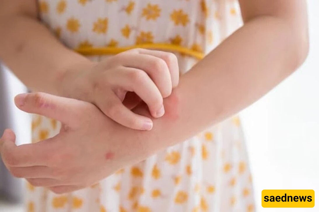 Eczema